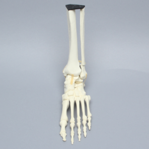 Foot and Ankle with Malleolar Fractures