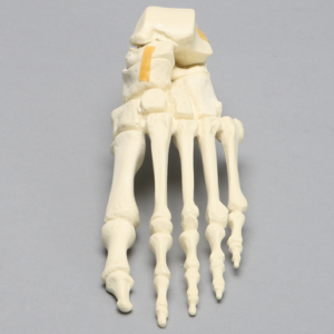 Foot includes a two-part fracture of the talus reattached with latex bands.
