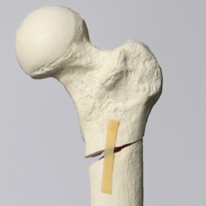 Femur with Subtrochanteric Oblique Fracture