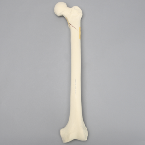 Femur with Subtrochanteric Spiral Fracture