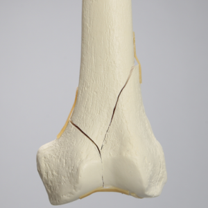 Femur with Bicondylar and Congenital Fractures