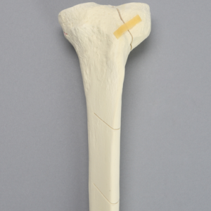 Tibia with Condylar, Oblique, and Spiral Fractures