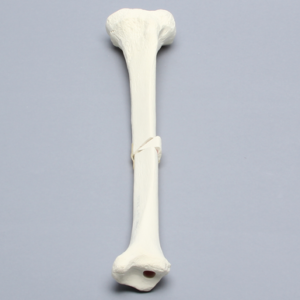 Tibia with Small Butterfly Fracture