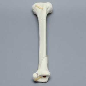 Tibia with Condylar, Malleolar, Oblique, and Spiral Fractures