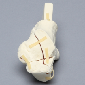Calcaneus with Five-Part Fracture, Foam Cortical, Left