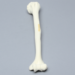 Humerus with Oblique Fracture, Foam Cortical