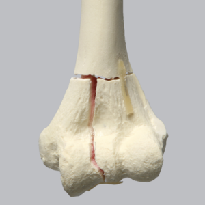 Humerus with Distal "T" Fracture, Foam Cortical