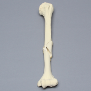 Humerus with Butterfly Fracture, Foam Cortical