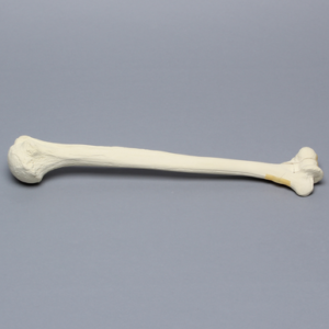 Humerus with "Y" Fracture, Foam Cortical