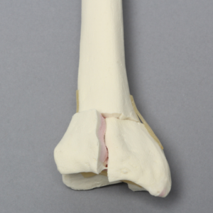 Radius with Three-Part Intra-Articular Fracture, Foam Cortical, Right