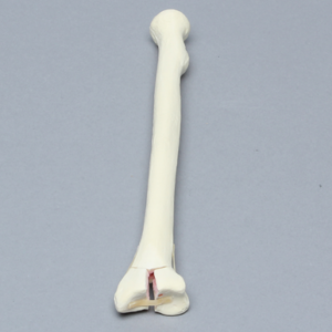 Radius with Three-Part Intra-Articular Fracture and Removed Tubercle, Foam Cortical