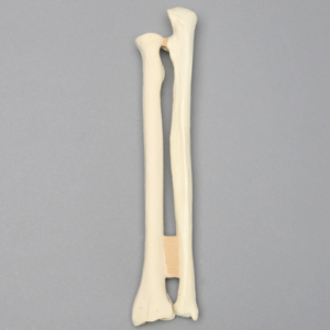 Ulna and Radius with Volar Fracture, Foam Cortical