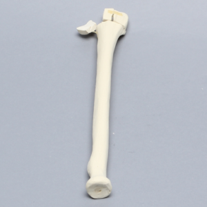 Radius with Distal Five-Part Intra-Articular Fracture, Foam Cortical