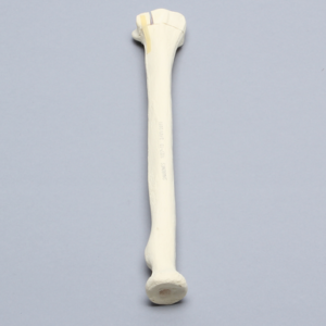 Radius with Transverse Fracture and Fragment, Foam Cortical