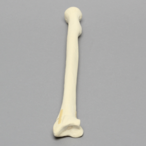 Radius with Transverse Fracture, Foam Cortical