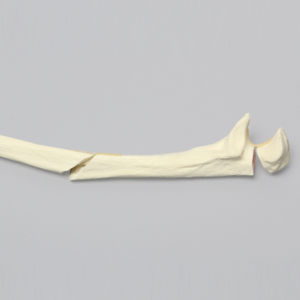 Ulna with Oblique and Transverse Fractures, Foam Cortical