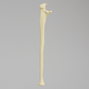 Ulna with Olecranon Fracture for Wire Tension Banding, Foam Cortical