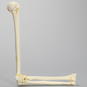 Elbow with Four-Part Fracture, Foam Cortical