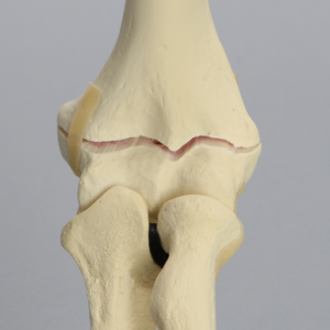 Elbow with Transverse Fracture, Foam Cortical