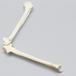Elbow with Radial Head and Coronid Fractures and Severed Ligament, Foam Cortical