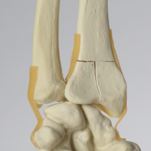 Hand and Wrist with Three-Part Fracture, Foam Cortical