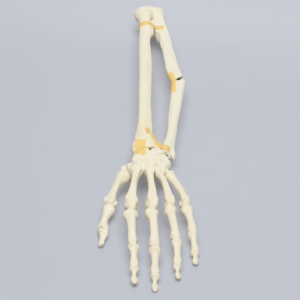 Hand and Wrist with Oblique and Colles' Fractures, Solid Foam