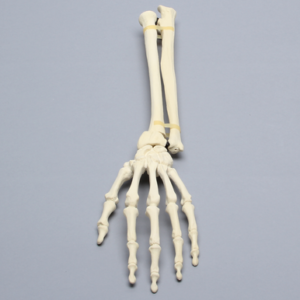Hand and Wrist with Colles' Fracture, Solid Foam