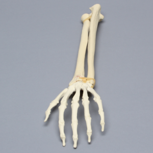 Hand and Wrist with Transverse Radial Fracture, Solid Foam