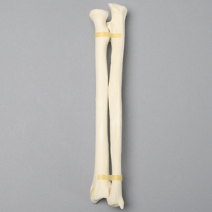 Ulna and Radius with Styloid Fracture, Foam Cortical