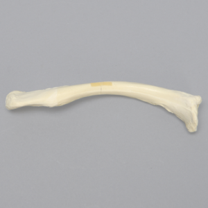 Clavicle with Transverse Fracture, Solid Foam