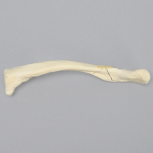Clavicle with Butterfly Fracture, Solid Foam
