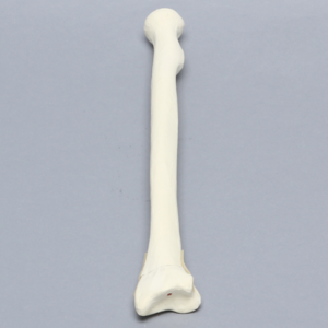 Radius with Transverse Colles' Fracture and Removed Tubercle, Foam Cortical