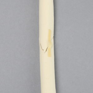 Radius with Oblique Fracture, Solid Foam