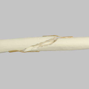 Radius with Long Oblique Fracture, 6.4mm Canal, Solid Foam