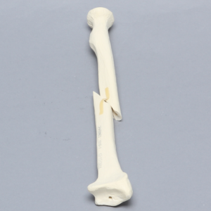 Radius with Short Oblique Fracture, 6.4mm Canal, Solid Foam