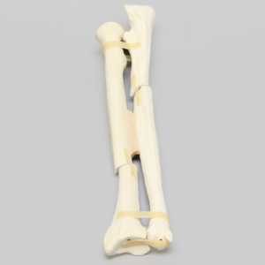 Ulna and Radius with Oblique and Transverse Fractures, Foam Cortical