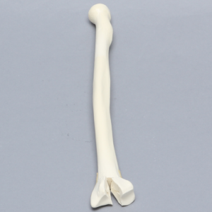 Radius, Three-Part Intra-Articular Fracture, Solid Foam