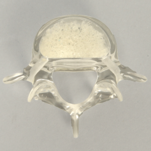 Vertebra L5 with Replaceable Insert, Transparent Cortical