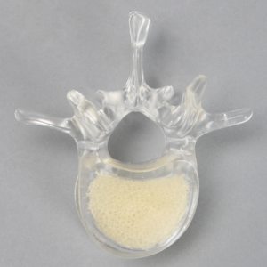 Vertebra L1 with Open Cell Cancellous, Solid Clear Plastic