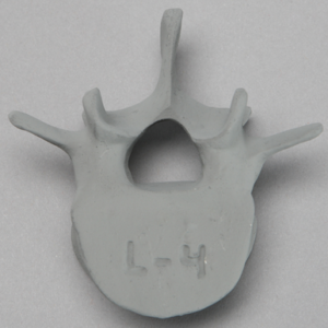 Vertebra, L4, Osteoporotic, Radiopaque