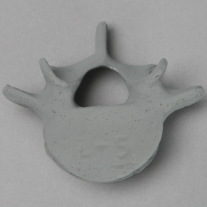 Vertebra, L5, Radiopaque