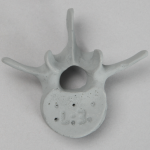 Vertebra, L3, Radiopaque