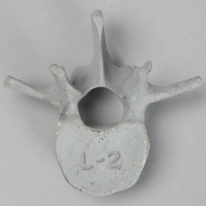 Vertebra, L2, Radiopaque