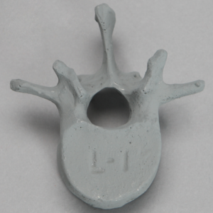 Vertebra, L1, Radiopaque