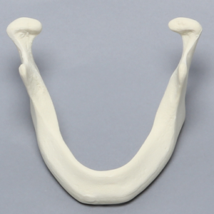 Mandible with Ridge Deformity