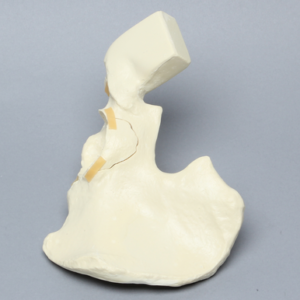 Hemi Pelvis with Wall Fractures, Solid Foam, Right