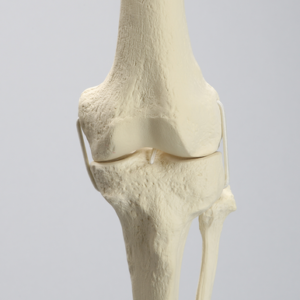 Knee Replacement with Tibia and Fibula