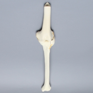 Knee with Plateau Fracture