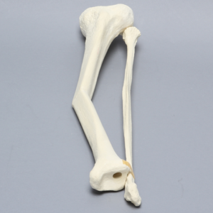 Tibia and Fibula with 30 Degree Valgus Fracture