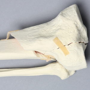 Tibia and Fibula with Type Six Tibial Plateau Fracture